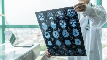 Exciting Discovery: Scientists Find Promising Treatment Target for Brain-Affecting Autoimmune Disease!