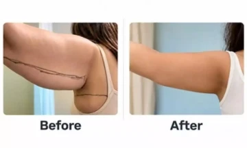 Zydus Hospitals Ahmedabad Highlights a Healthier Approach to Post-Weight-Loss Transformation