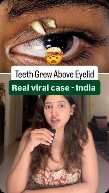 Can Your Teeth Grow Near Your Eyes? A 16-Year-Old Boy in Madurai Proves Human Anatomy Can Still Shock Us! 🦷😲